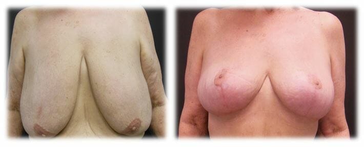 Mastopexy29 Mastopexy by Dr Thomassen
