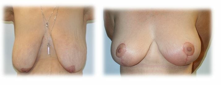 Mastopexy30 Mastopexy by Dr Thomassen