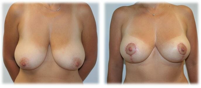 Mastopexy4 Mastopexy by Dr Thomassen