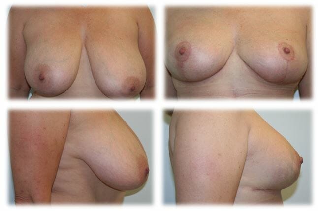Mastopexy5 Mastopexy by Dr Thomassen