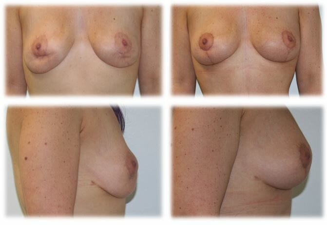 Mastopexy6 Mastopexy by Dr Thomassen