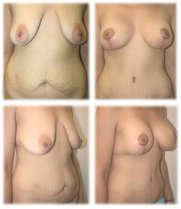 Mommy Makeover1 Mommy makeover by Dr. Thomassen