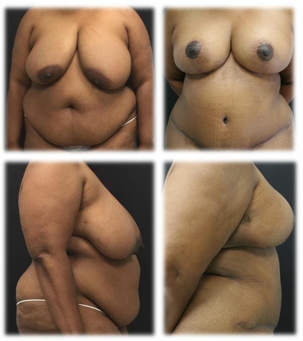 Mommy Makeover11 Mommy makeover by Dr. Thomassen