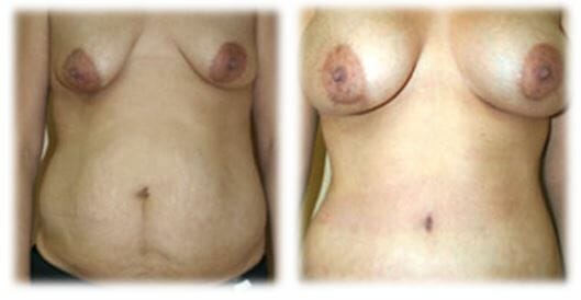 Mommy Makeover15 Mommy makeover by Dr. Thomassen