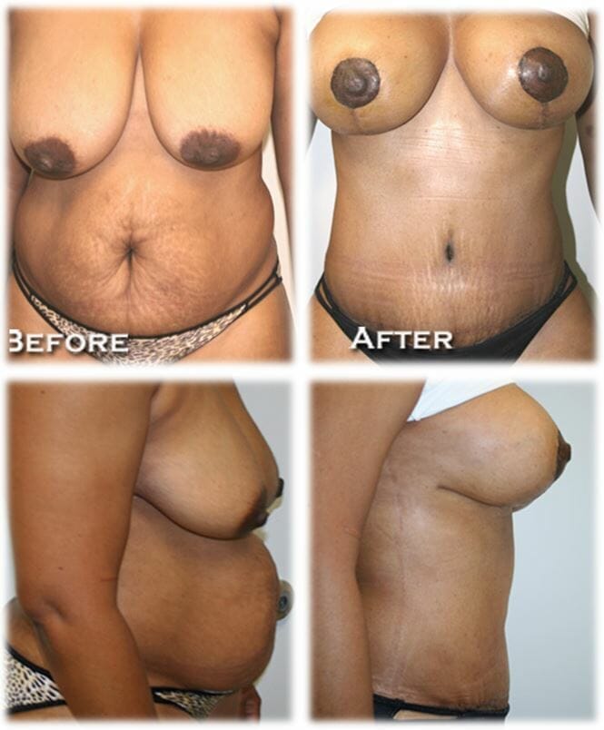 Mommy Makeover2 Mommy makeover by Dr. Thomassen