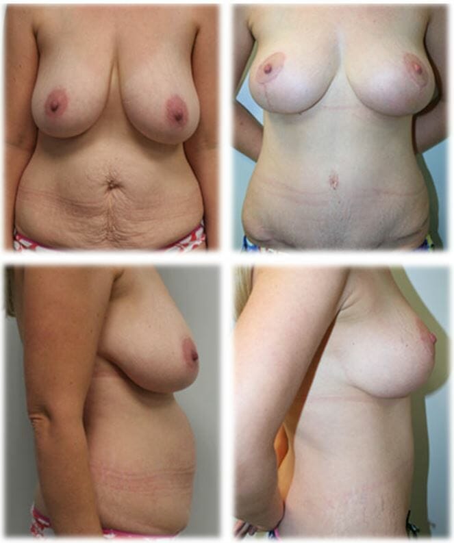 Mommy Makeover3 Mommy makeover by Dr. Thomassen