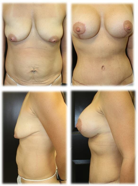 Mommy Makeover4 Mommy makeover by Dr. Thomassen