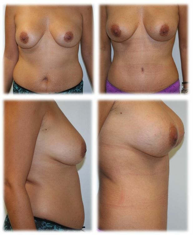 Mommy Makeover6 Mommy makeover by Dr. Thomassen