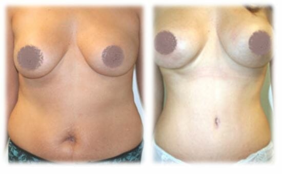 Mommy Makeover7 Mommy makeover by Dr. Thomassen