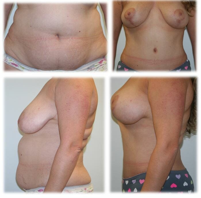 Mommy Makeover8 Mommy makeover by Dr. Thomassen