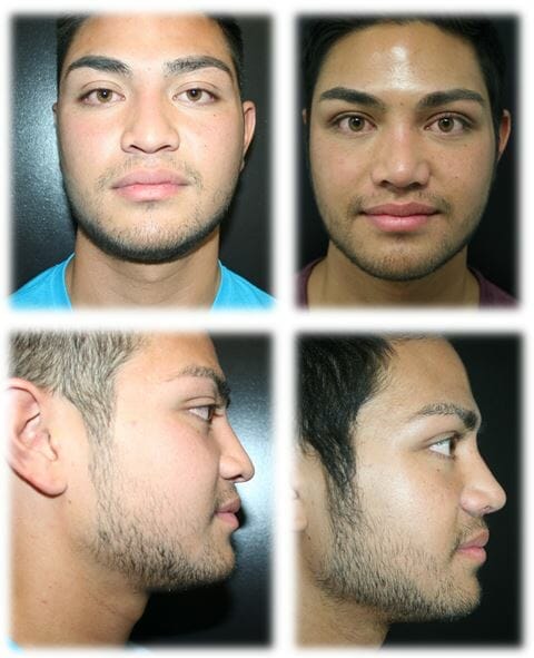 Rhinoplasty11
