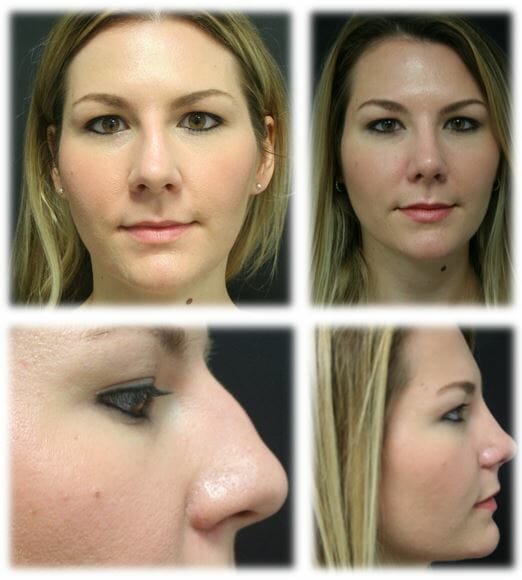 Rhinoplasty14