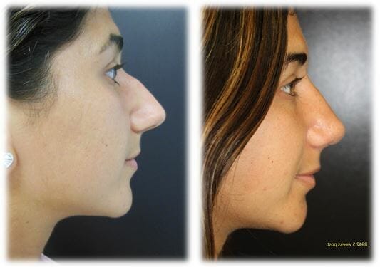 Rhinoplasty17