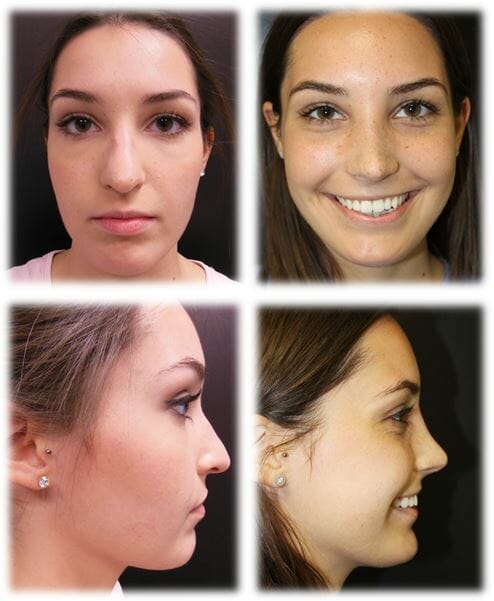 Rhinoplasty Before and Afters