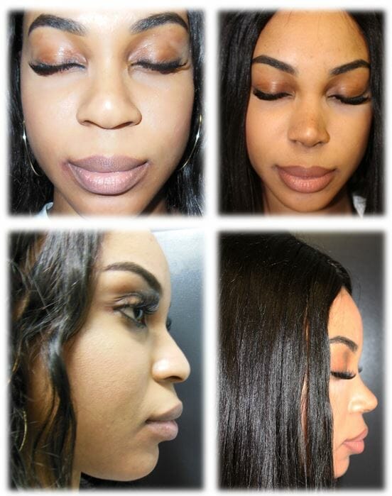 Rhinoplasty Before and Afters