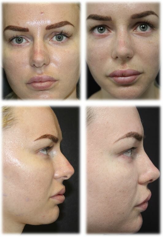Rhinoplasty21