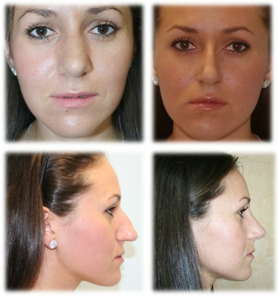 Rhinoplasty23