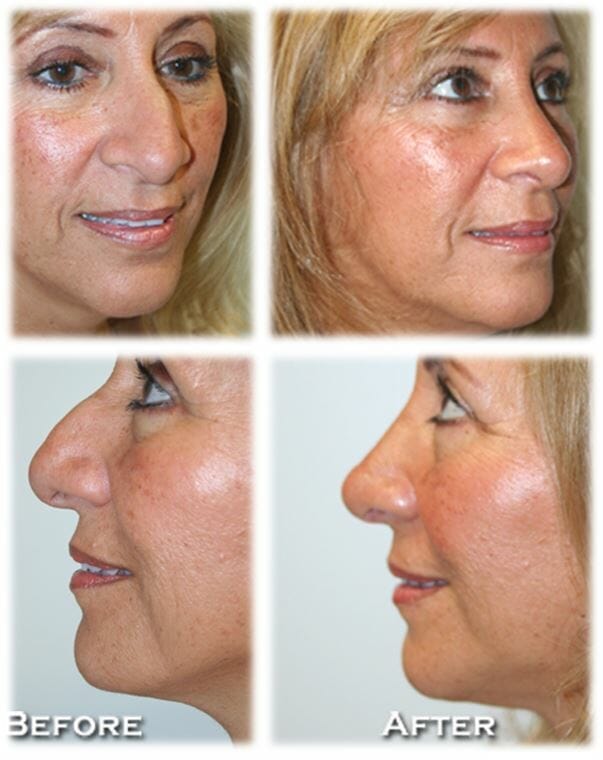 Rhinoplasty25