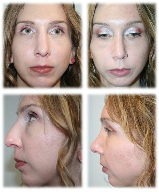 Rhinoplasty30