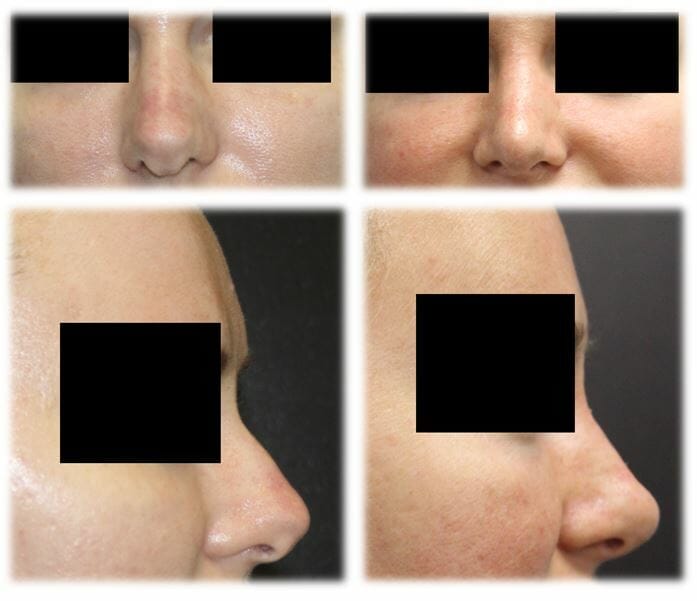 Rhinoplasty Before and Afters