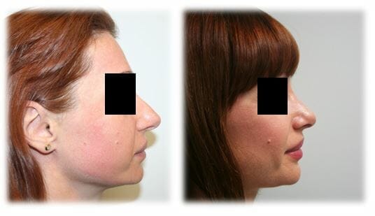 Before and After Rhinoplasty by Dr. Thomssen in Fort Lauderdale