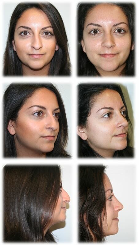 Rhinoplasty Before and Afters