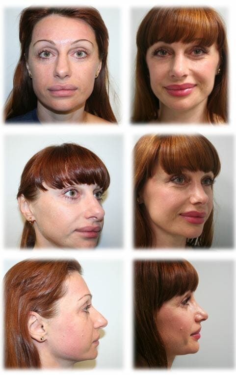 Rhinoplasty1