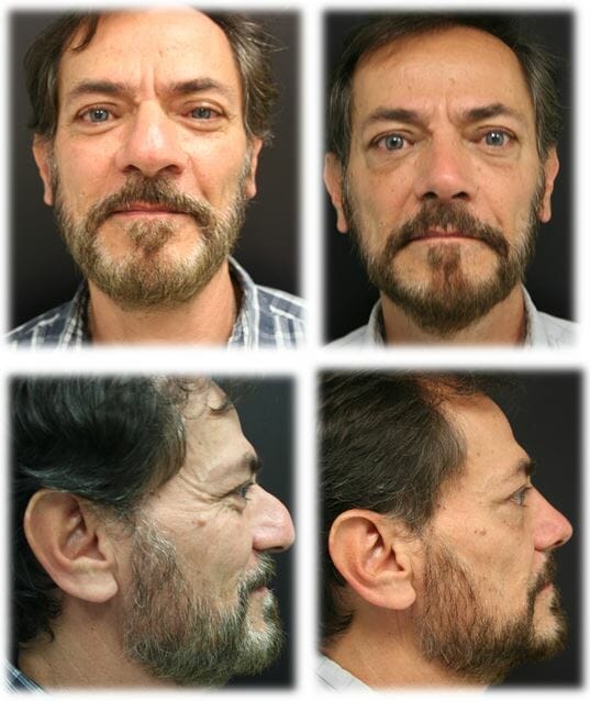 Rhinoplasty Before and Afters