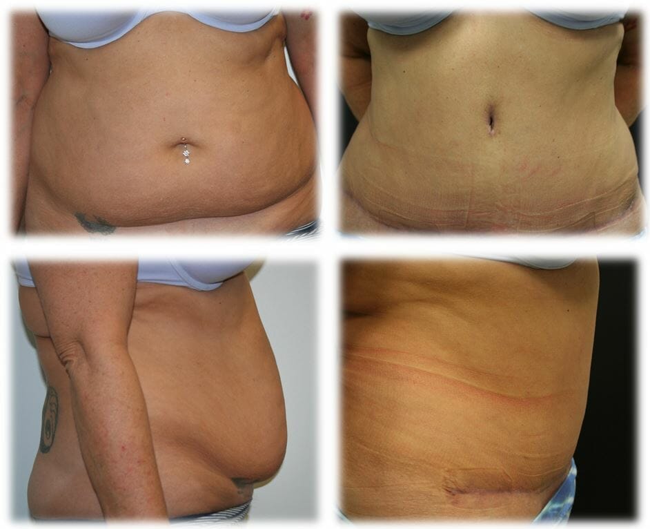 Abdominoplasty (Tummy Tuck) by Dr. Thomassen