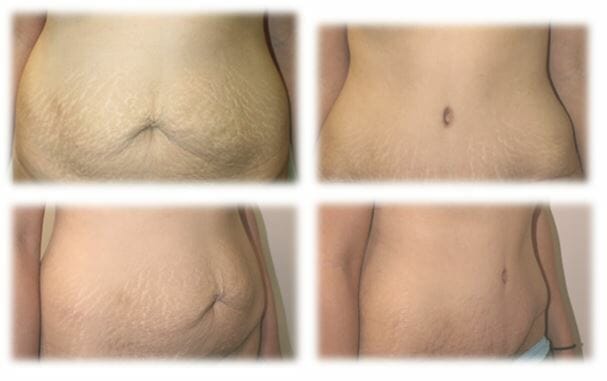 Abdominoplasty (Tummy Tuck) by Dr. Thomassen