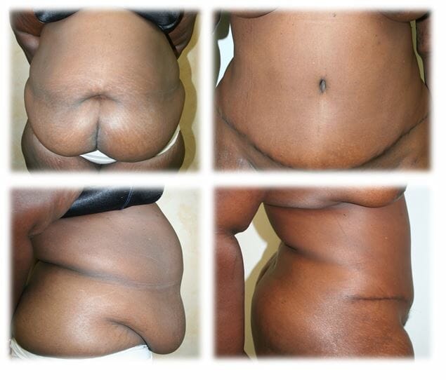 Abdominoplasty (Tummy Tuck) by Dr. Thomassen