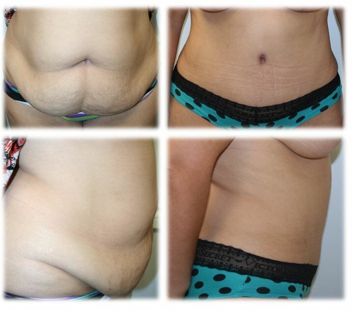Abdominoplasty (Tummy Tuck) by Dr. Thomassen