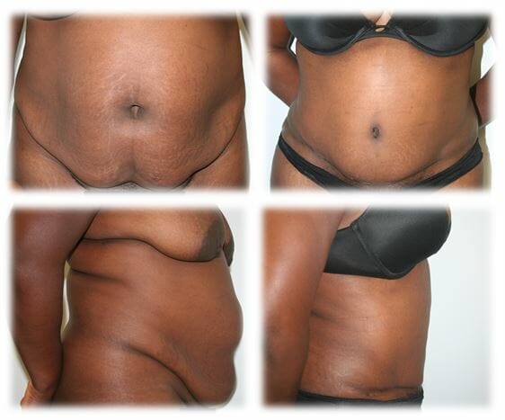 Abdominoplasty (Tummy Tuck) by Dr. Thomassen