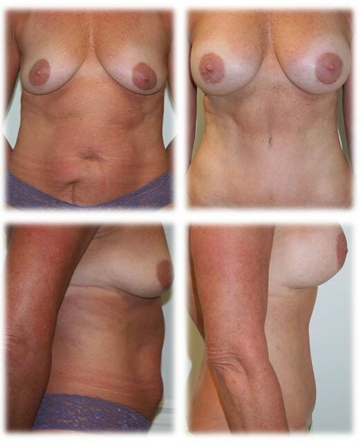 Abdominoplasty (Tummy Tuck) by Dr. Thomassen