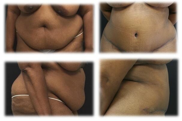 Abdominoplasty (Tummy Tuck) by Dr. Thomassen