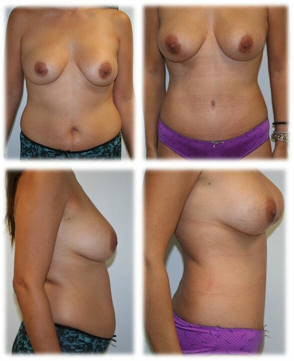 Abdominoplasty (Tummy Tuck) by Dr. Thomassen