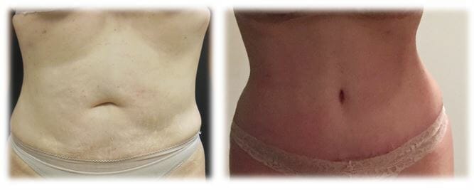 Abdominoplasty (Tummy Tuck) by Dr. Thomassen