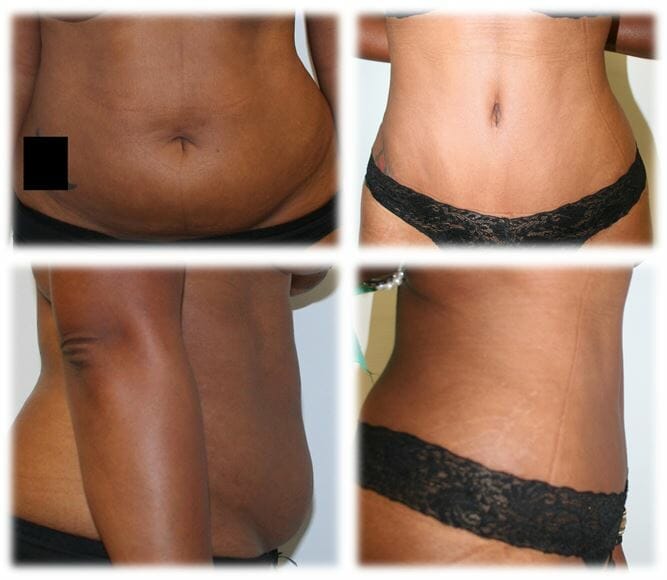 Abdominoplasty (Tummy Tuck) by Dr. Thomassen
