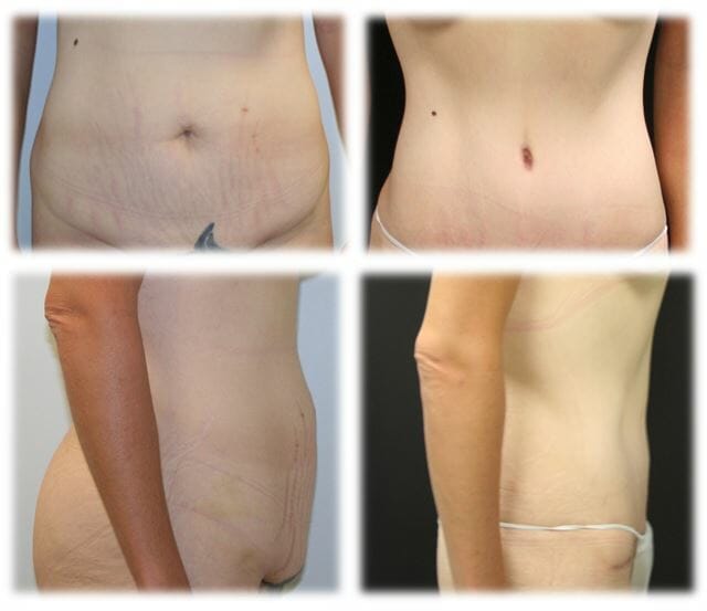 Abdominoplasty (Tummy Tuck) by Dr. Thomassen