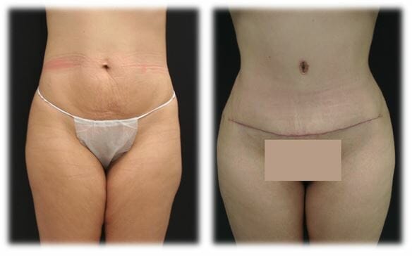 Abdominoplasty (Tummy Tuck) by Dr. Thomassen