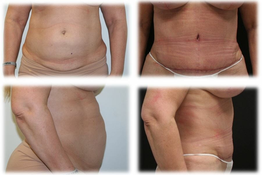 Abdominoplasty (Tummy Tuck) by Dr. Thomassen