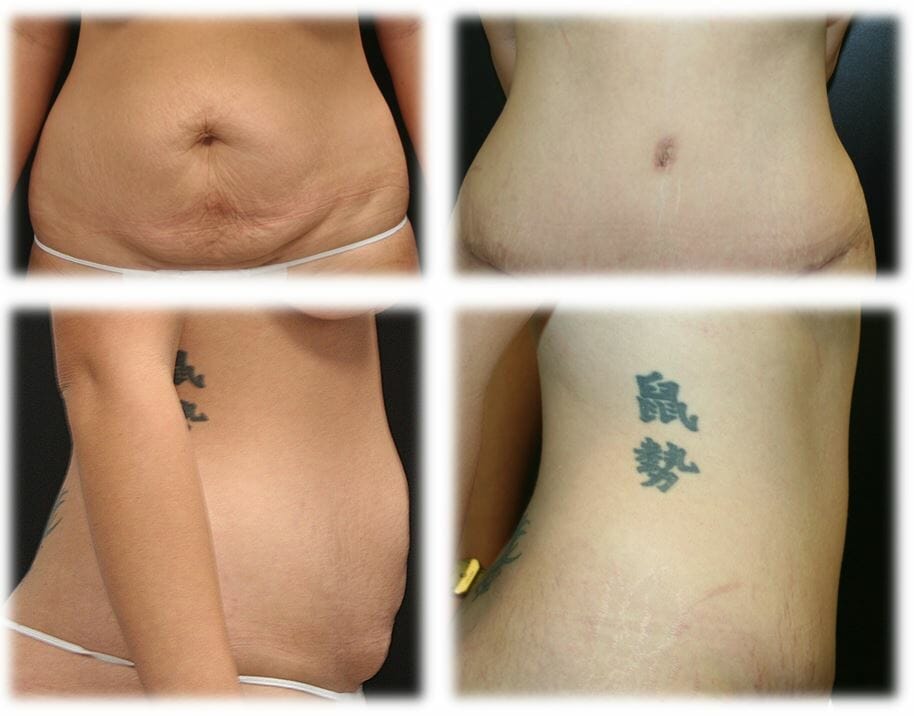 Abdominoplasty (Tummy Tuck) by Dr. Thomassen
