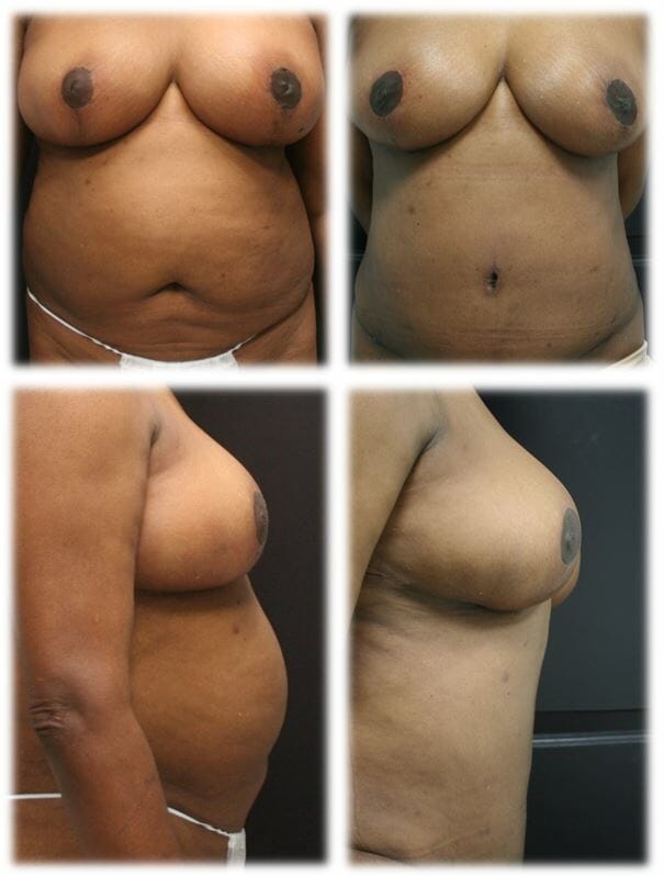 Abdominoplasty (Tummy Tuck) by Dr. Thomassen