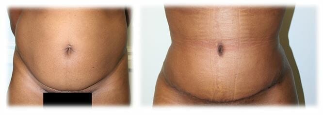 Abdominoplasty (Tummy Tuck) by Dr. Thomassen