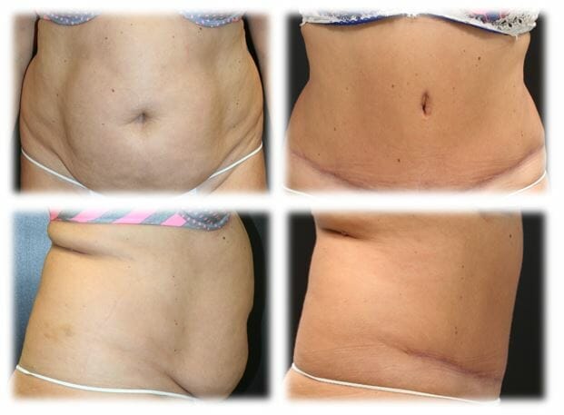 Abdominoplasty (Tummy Tuck) by Dr. Thomassen