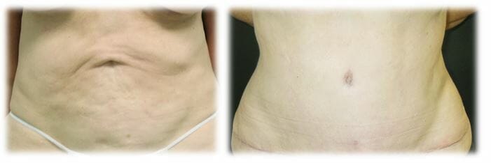Abdominoplasty (Tummy Tuck) by Dr. Thomassen