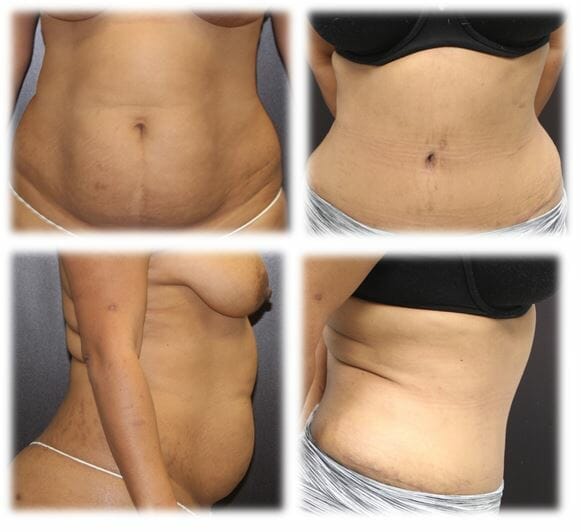 Abdominoplasty (Tummy Tuck) by Dr. Thomassen