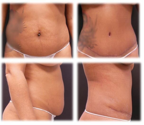 Abdominoplasty (Tummy Tuck) by Dr. Thomassen