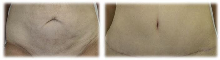 Abdominoplasty (Tummy Tuck) by Dr. Thomassen