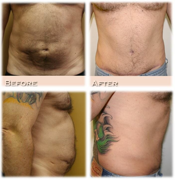 Tummy tuck46 Male Abdominoplasty (Tummy tuck) by Dr. Thomassen